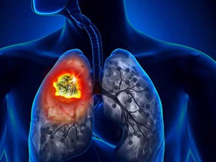 Người đàn ông được phát hiện ung thư phổi sau 10 ngày ho khan, cảnh báo dấu hiệu sớm của bệnh phải cẩn trọng