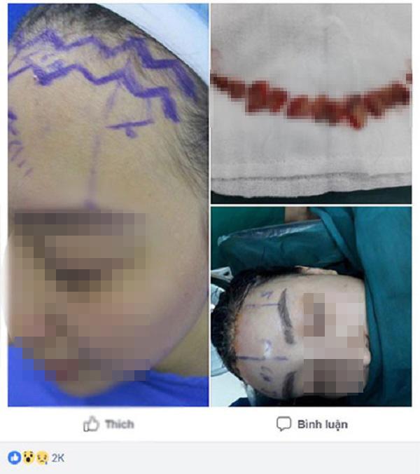 Sửa mũi cắt môi đã là gì, chị em bây giờ còn rủ nhau đi cắt da đầu để...-1