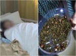Chăm con thừa chất, bé trai 12 tuổi ở Hà Nội đầy sỏi trong mật-3