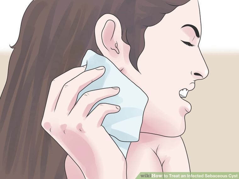 Cẩn thận nếu thấy cục hạch sau tai vì nó có thể là dấu hiệu của nhiều bệnh nguy hiểm, bao gồm cả ung thư-4