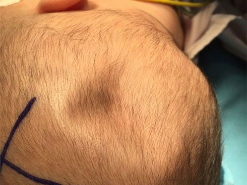 Cảnh giác với tình trạng chấn thương đầu của trẻ do té ngã