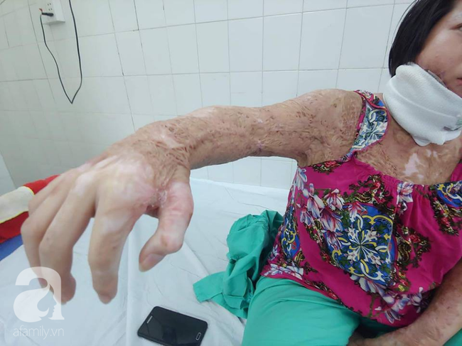 Người vợ bị chồng dùng xăng đốt vì níu kéo tình cảm không thành: Tết này em được về với con rồi-3