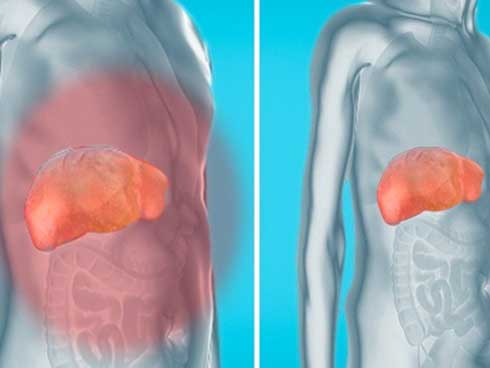 Bàng quang của bệnh nhân đột nhiên phát nổ, nguyên nhân là do thói quen ăn uống này-3