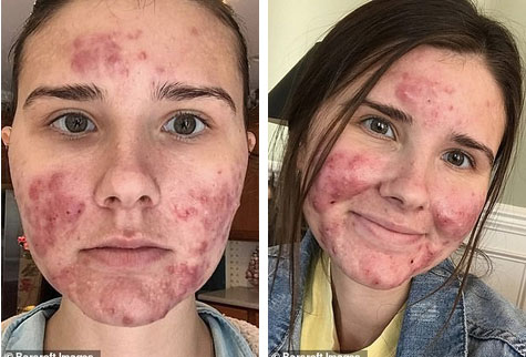 Bị mụn nghiêm trọng đến nỗi đau đớn, không thể ra ngoài mà không trang điểm, cô gái này đã làm thế nào?-1