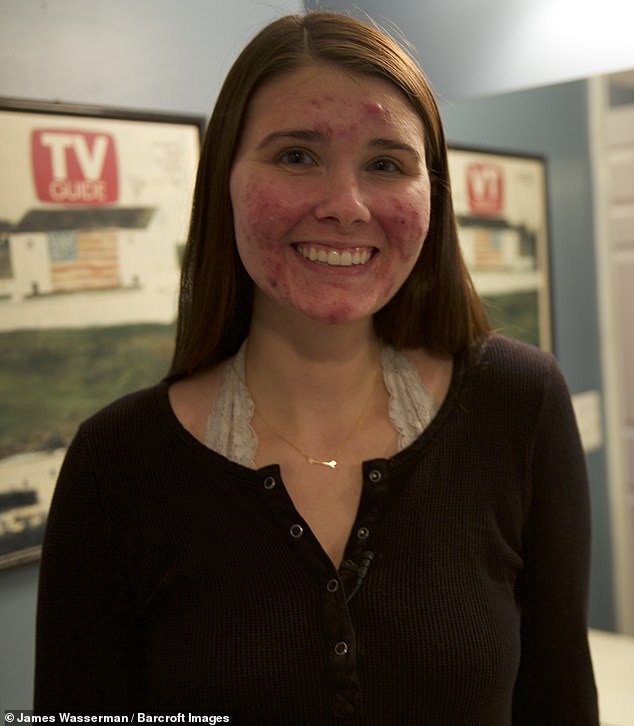 Bị mụn nghiêm trọng đến nỗi đau đớn, không thể ra ngoài mà không trang điểm, cô gái này đã làm thế nào?-4