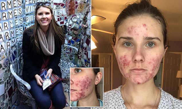 Bị mụn nghiêm trọng đến nỗi đau đớn, không thể ra ngoài mà không trang điểm, cô gái này đã làm thế nào?-2