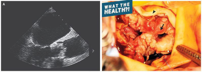 Đi khám bác sĩ khi bị sốt và khó thở, người đàn ông thiệt mạng vì căn bệnh đáng sợ này ở tim-1