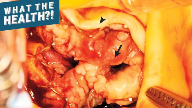 Đi khám bác sĩ khi bị sốt và khó thở, người đàn ông thiệt mạng vì căn bệnh đáng sợ này ở tim-2