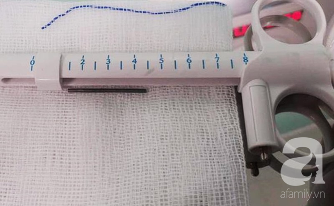 Tai nạn kinh hoàng cận Tết: Cầm bút chì chơi rồi vấp ngã, bé gái 6 tuổi bị đâm xuyên từ mũi đến hốc mắt-3