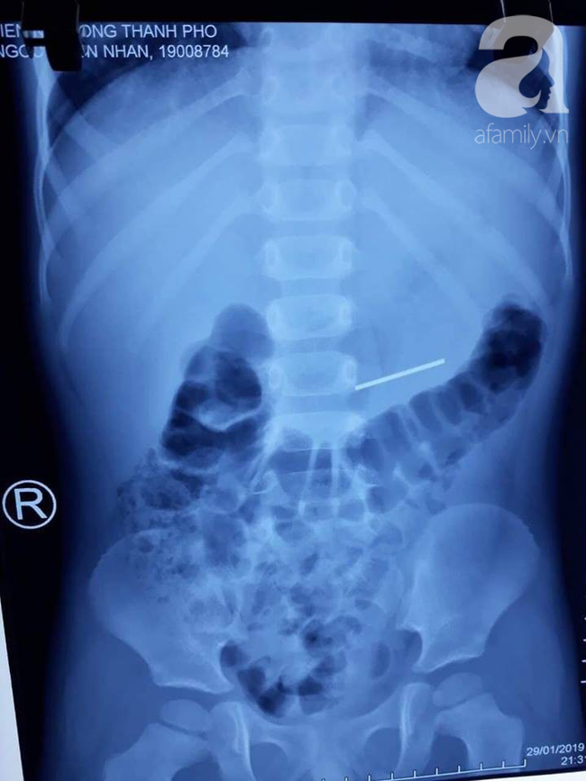 Tai nạn kinh hoàng cận Tết: Cầm bút chì chơi rồi vấp ngã, bé gái 6 tuổi bị đâm xuyên từ mũi đến hốc mắt-4