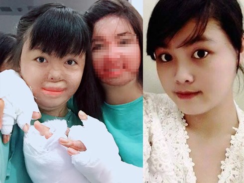 Người vợ xinh đẹp bị chồng đốt ngày mùng 2 Tết giờ ra sao?