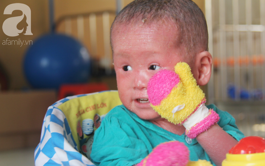 Hình ảnh ấm áp năm mới: bé Bích bị bỏ rơi, người đầy vẩy ngứa như da trăn ngày nào đã tập đi, tập nói-2