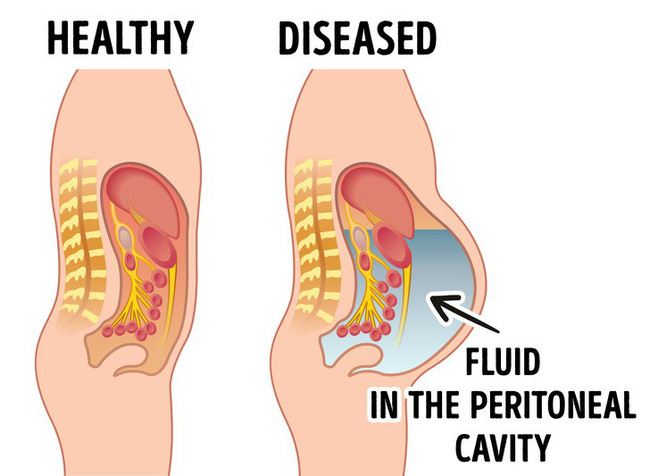 8 dấu hiệu bất ngờ của bệnh gan cho thấy bạn cần đến bác sĩ càng sớm càng tốt-4