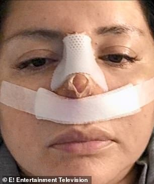 Đi hút mỡ để cải thiện ngoại hình, cô gái trẻ gặp phải bác sĩ có tâm khuyến mãi thêm chiếc mũi thảm họa-2