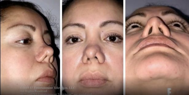 Đi hút mỡ để cải thiện ngoại hình, cô gái trẻ gặp phải bác sĩ có tâm khuyến mãi thêm chiếc mũi thảm họa-4