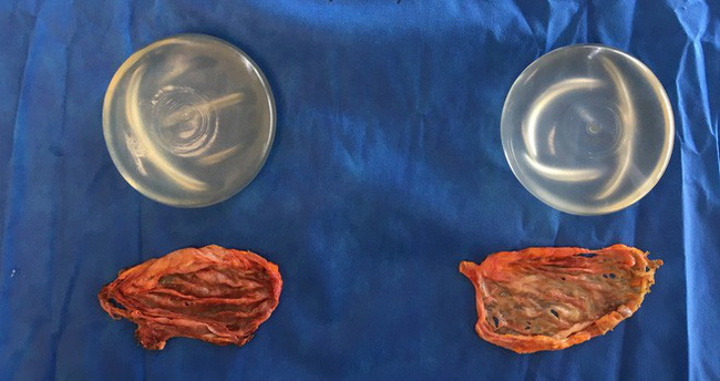 Hàng trăm trường hợp mắc ung thư sau phẫu thuật nâng ngực được phát hiện tại Mỹ-1