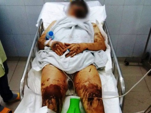 Một vụ tạt axit, hủy hoại thân thể gây rúng động Quảng Ngãi