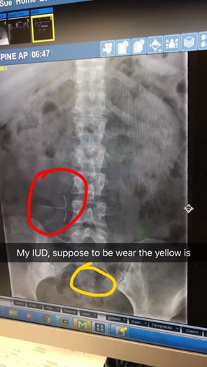 Từ trường hợp vòng tránh thai đi lạc 10 năm trong cơ thể người phụ nữ: Có nên tránh thai theo cách này?-1