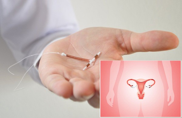 Từ trường hợp vòng tránh thai đi lạc 10 năm trong cơ thể người phụ nữ: Có nên tránh thai theo cách này?-6