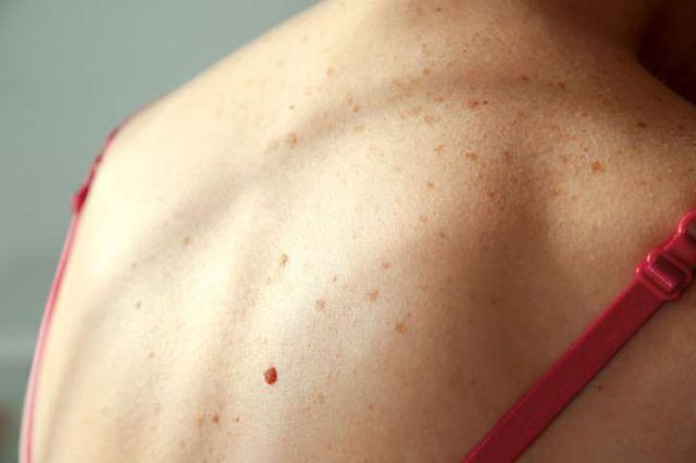 Vết bầm tím trên da người phụ nữ này suốt bao năm hóa ra là dấu hiệu cảnh báo bệnh cực nguy hiểm!-3