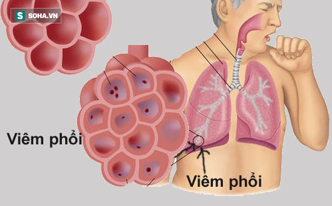 4 loại thực phẩm vàng tốt nhất cho phổi: Người có bệnh thì nên ăn nhiều để giảm viêm-1