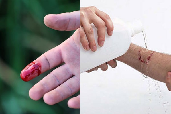 Nếu không may bị đứt tay thì đây chính xác là những gì bạn phải làm-1