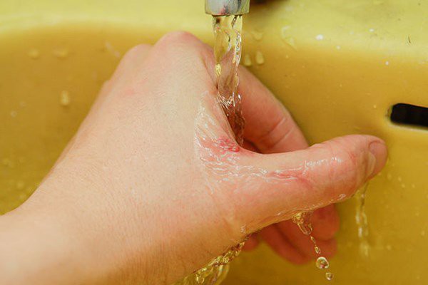 Nếu không may bị đứt tay thì đây chính xác là những gì bạn phải làm-3