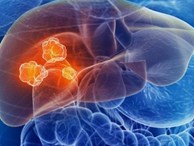 Cẩn thận với các khối u phát triển âm thầm trong gan: Đây là 4 tín hiệu sớm nhất cần biết