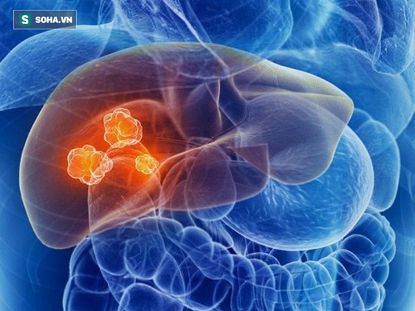 Cẩn thận với các khối u phát triển âm thầm trong gan: Đây là 4 tín hiệu sớm nhất cần biết-1