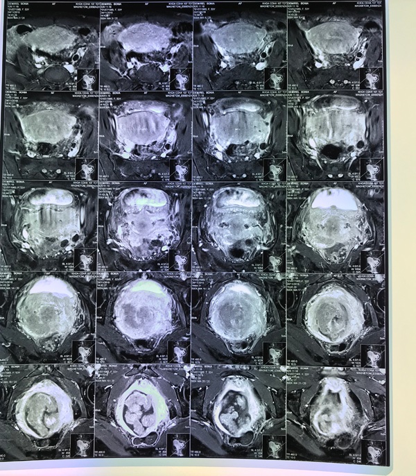 Ra máu nhiều, bác sĩ thông báo ung thư tử cung giai đoạn cuối-1