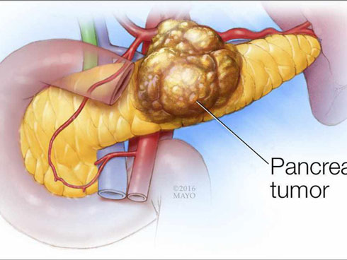 Làm việc này 5 lần/tuần để giảm nguy cơ mắc 13 loại ung thư, đặc biệt là ung thư gan-3
