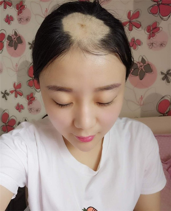 Mỹ nữ hói đầu vì ăn ngô bằng máy khoan khiến cư dân mạng bất ngờ trước diện mạo và cuộc sống hiện tại-2