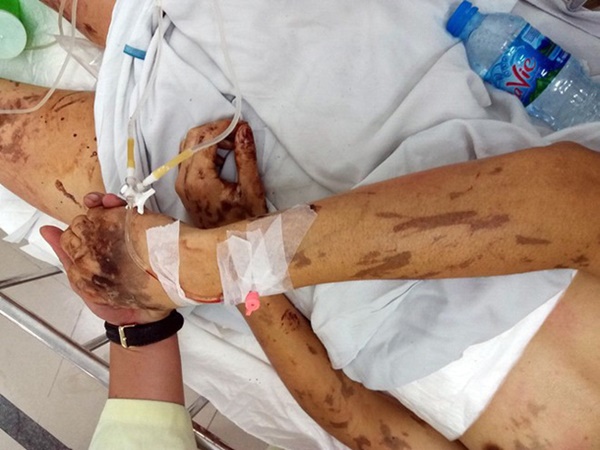 Nhiều tình tiết mới trong vụ tạt axit, cắt gân chân Việt kiều Canada-1