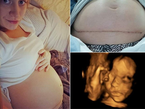 Đỡ đẻ cho một sản phụ xong, bác sĩ chết điếng người khi nhìn thấy một thai nhi khác đã hình thành tay chân trong bụng bé gái mới sinh-7