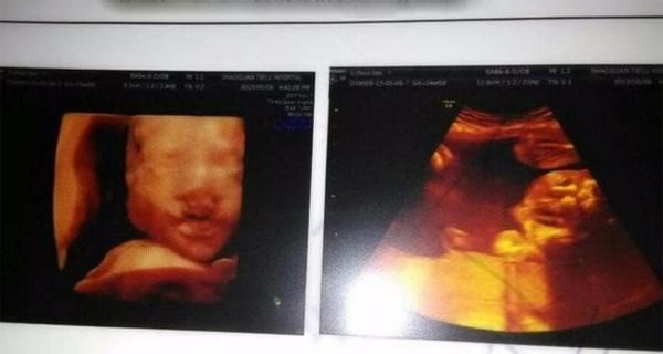 Siêu âm thấy con bị hở hàm ếch, mẹ chết đứng nghe bác sĩ chỉ đích danh mình là thủ phạm” hại con ra nông nỗi này-1