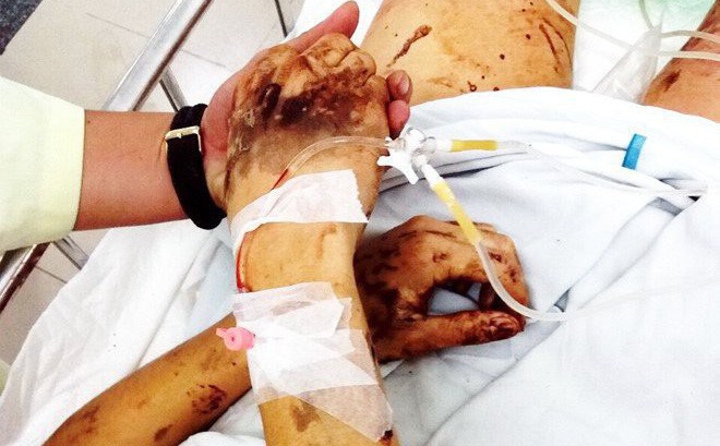 Nam Việt kiều Canada bị tạt axit hỏi anh trai tại hiện trường: Sao anh làm vậy với em?-2