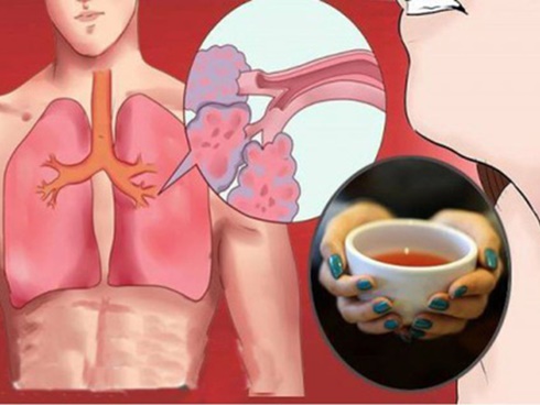 Chiếc xương vịt nằm trong đường thở suốt 10 tháng người phụ nữ Việt-3