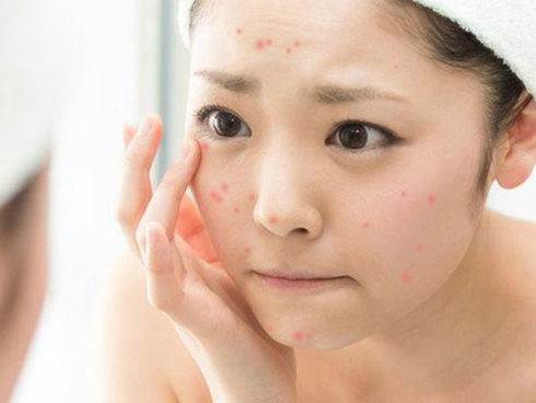 Mặt rỗ như tổ ong bầu cũng được lấp đầy nếu bạn làm việc này mỗi tối-9