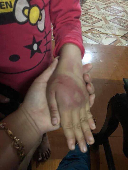 Người cha nghiện ngập bỏ trốn sau khi đánh con gái 8 tuổi bầm tím khắp cơ thể-2