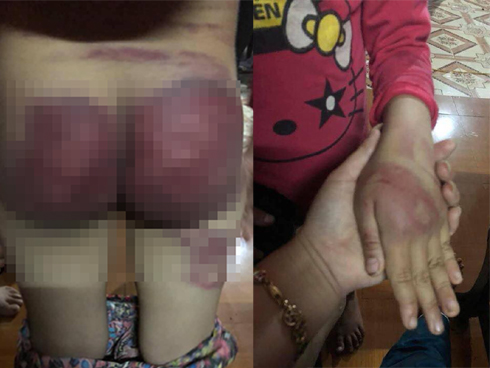 Cha đánh con gái 12 tuổi nhập viện-3