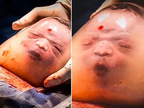 Bé gái Hải Dương chào đời vẫn nằm yên trong bọc ối-2