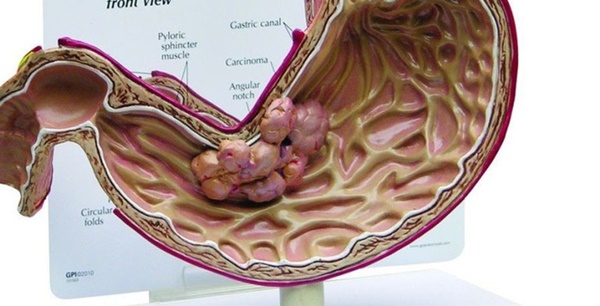 5 anh em nhưng 4 người bị ung thư dạ dày, sát thủ ở ngay trong chính bữa ăn-1