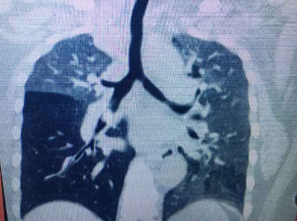 Chiếc xương vịt nằm trong đường thở suốt 10 tháng người phụ nữ Việt-1