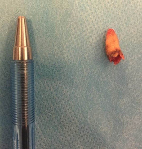 Chuyện lạ có thật: người đàn ông mọc răng trong mũi-2