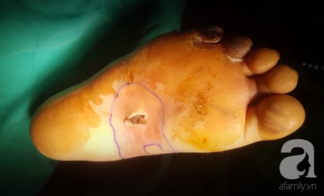 Nghĩ bị nhiễm trùng nặng do mang dép kẹp, đến khi đi khám bệnh người phụ nữ này mới tá hỏa vì mắc phải căn bệnh nguy hiểm-1