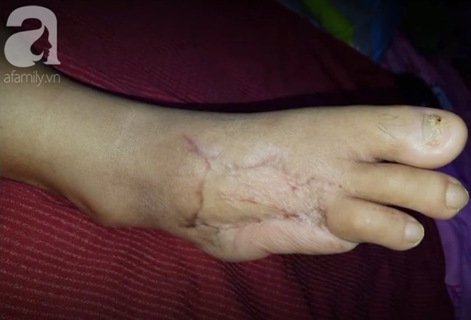 Nghĩ bị nhiễm trùng nặng do mang dép kẹp, đến khi đi khám bệnh người phụ nữ này mới tá hỏa vì mắc phải căn bệnh nguy hiểm-2