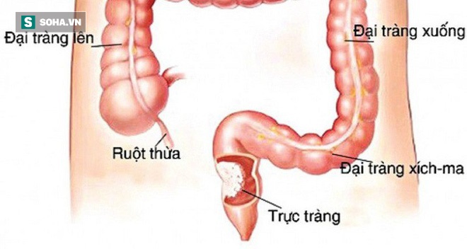 5 việc làm để ngăn chặn nguy cơ mắc ung thư trực tràng: Đừng để mầm bệnh lớn rồi mới biết-1