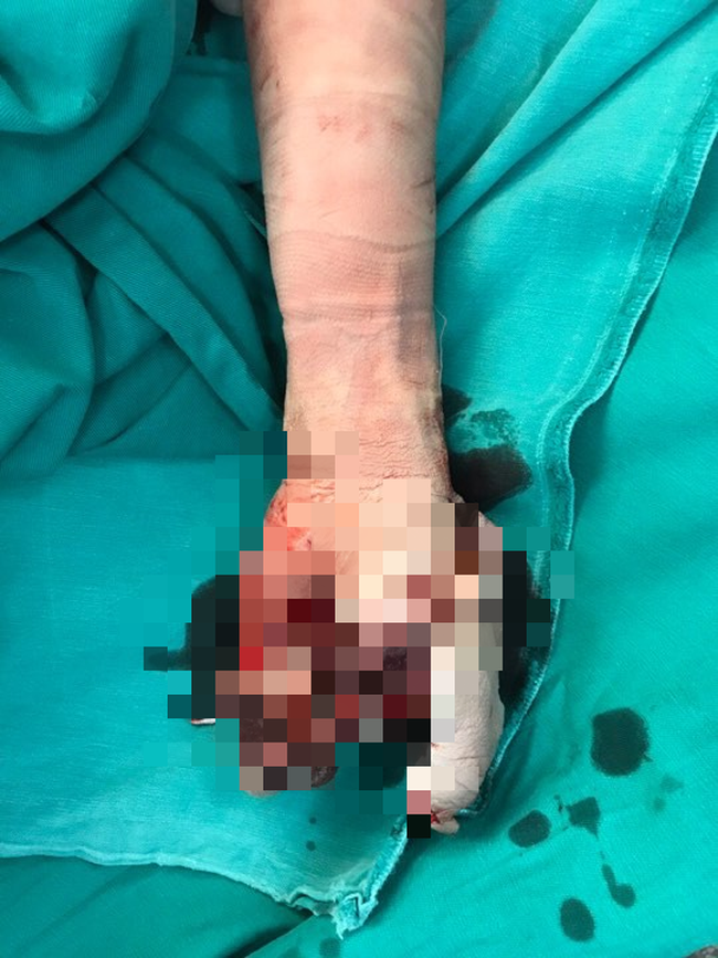 Dùng điện thoại iPhone khi đang sạc, bé trai 13 tuổi bị nổ tung bàn tay-1