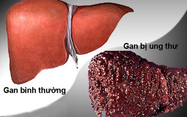 Ung thư gan đứng đầu trong các bệnh ung thư ở VN: GĐ BV Ung bướu chỉ 5 dấu hiệu cảnh báo-1