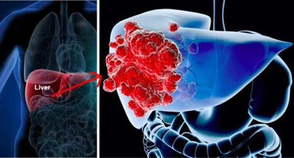 Ung thư gan đứng đầu trong các bệnh ung thư ở VN: GĐ BV Ung bướu chỉ 5 dấu hiệu cảnh báo-2